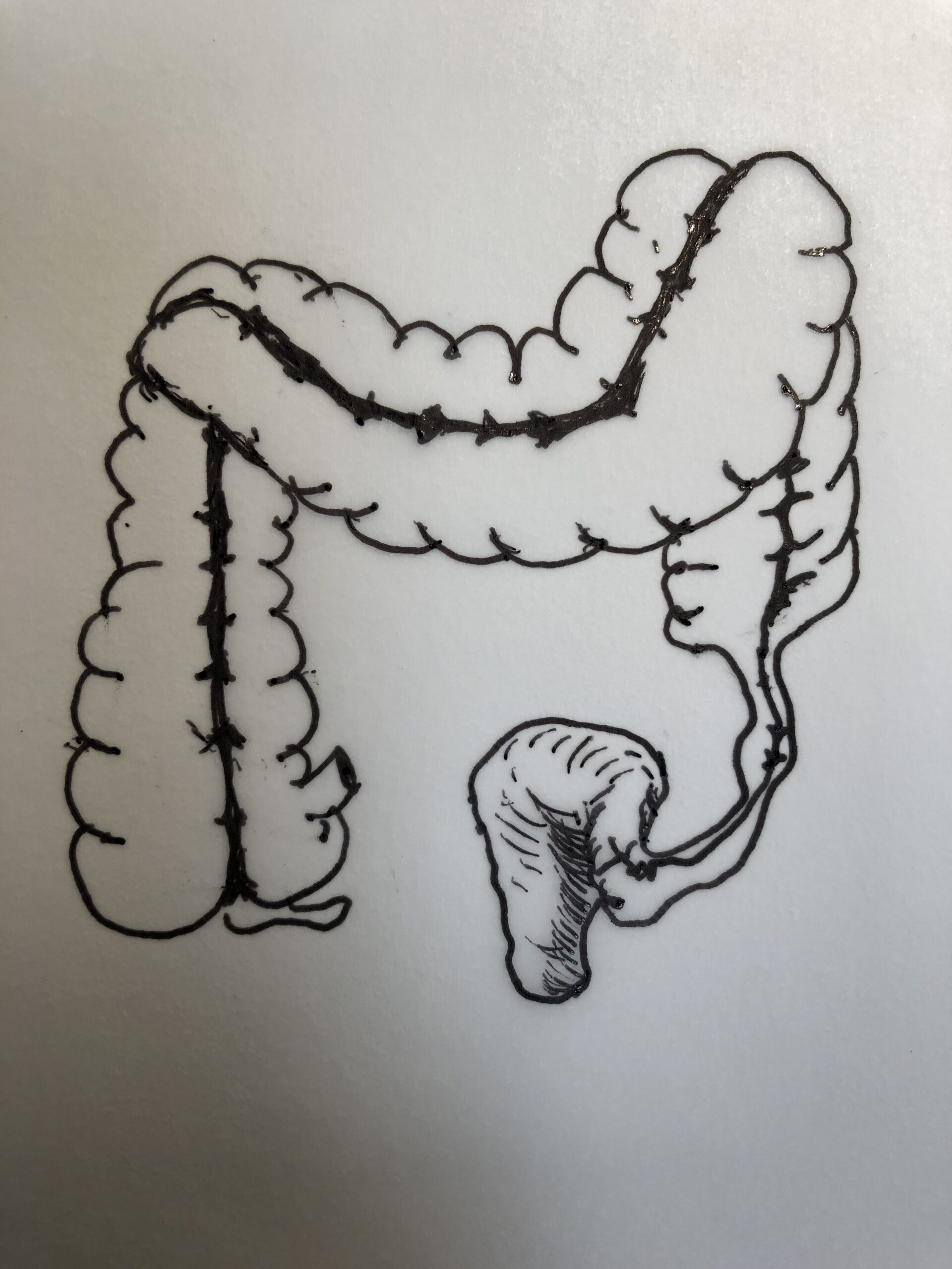 過敏性腸症候群の大腸